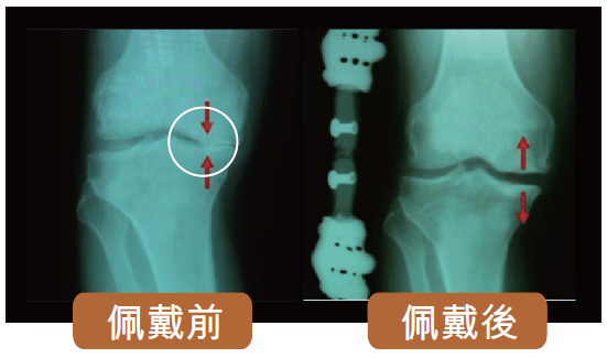 X光成效見證